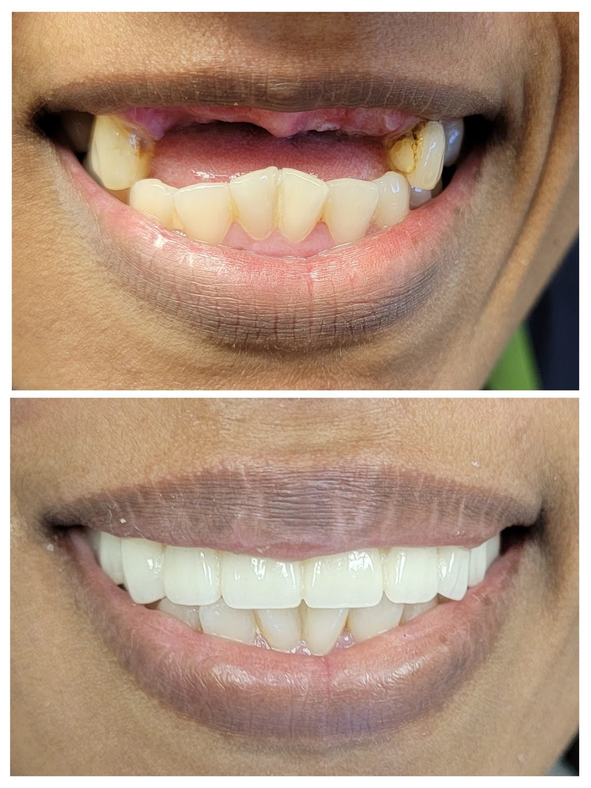 Fixed bridge — Smile Studio patient result