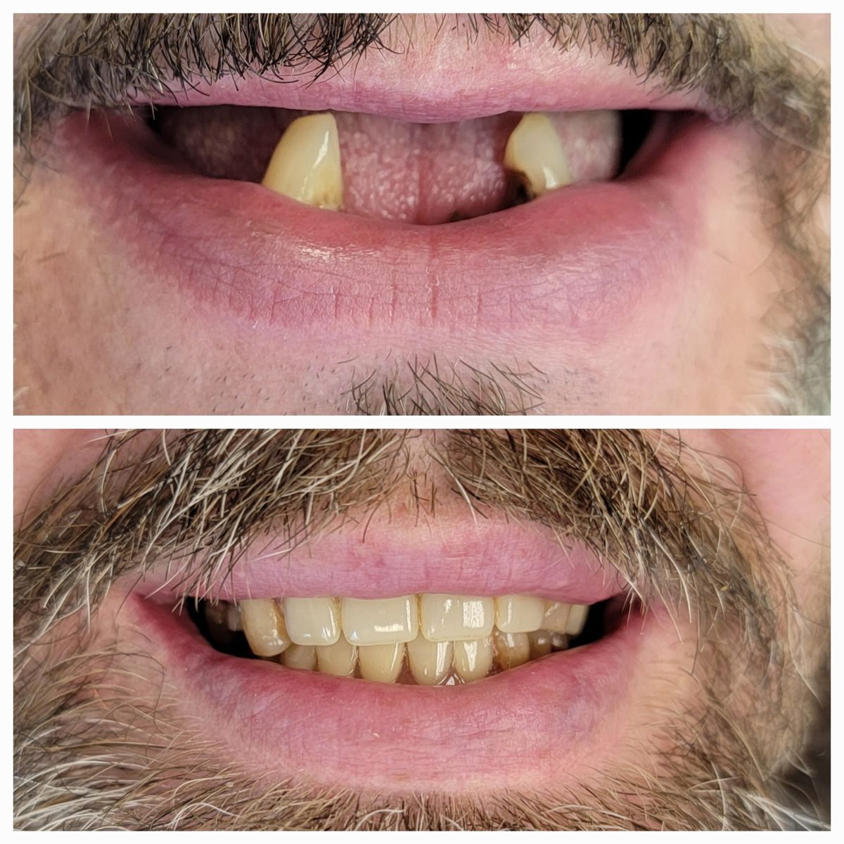 Complete denture — Smile Studio patient result