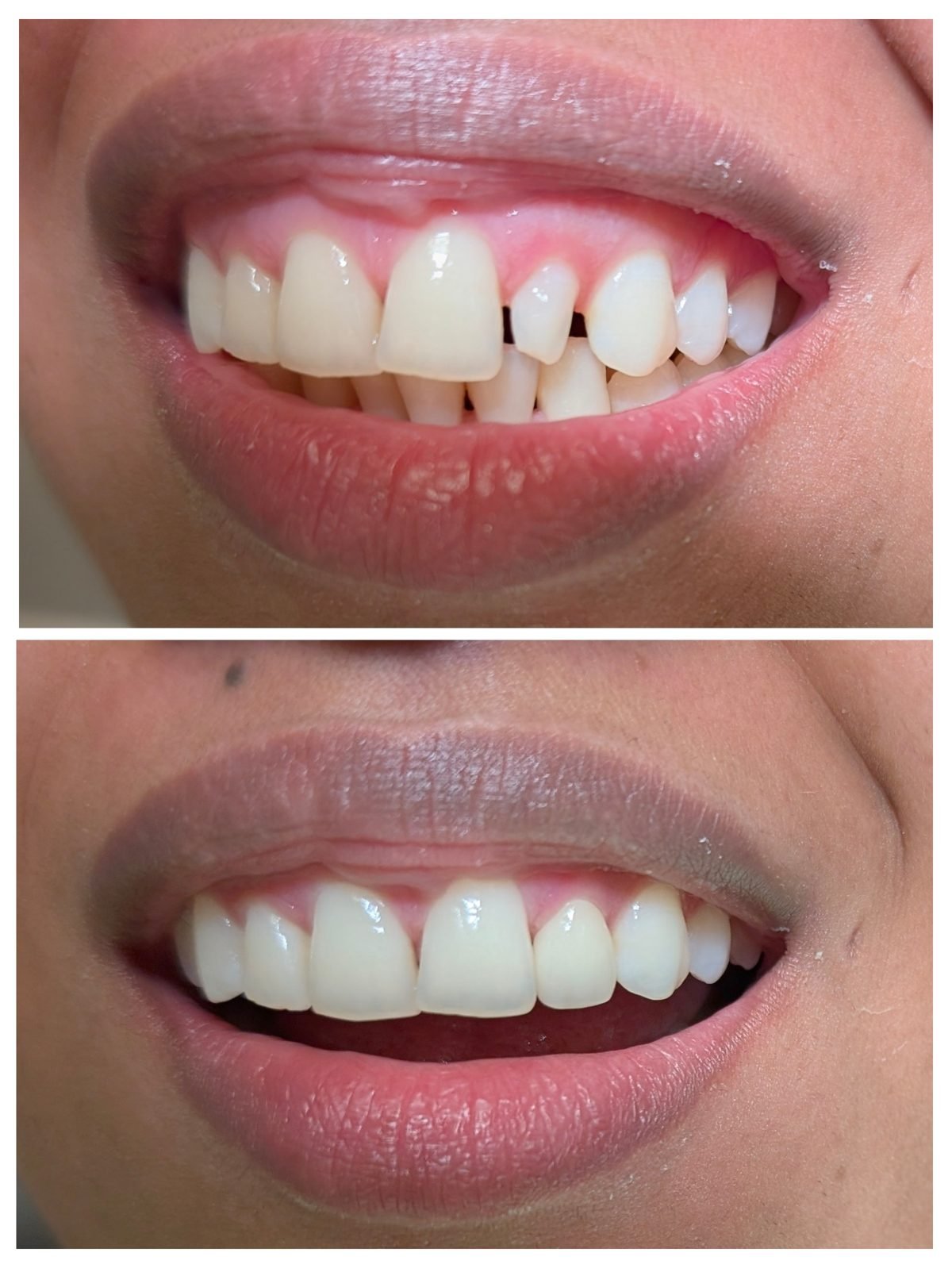 No-prep veneer — Smile Studio patient result