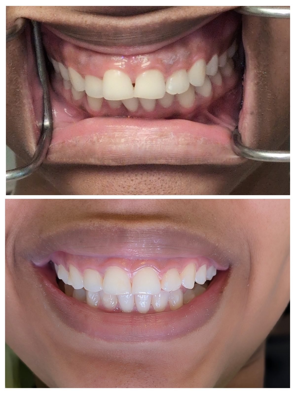 Invisalign — Smile Studio patient result