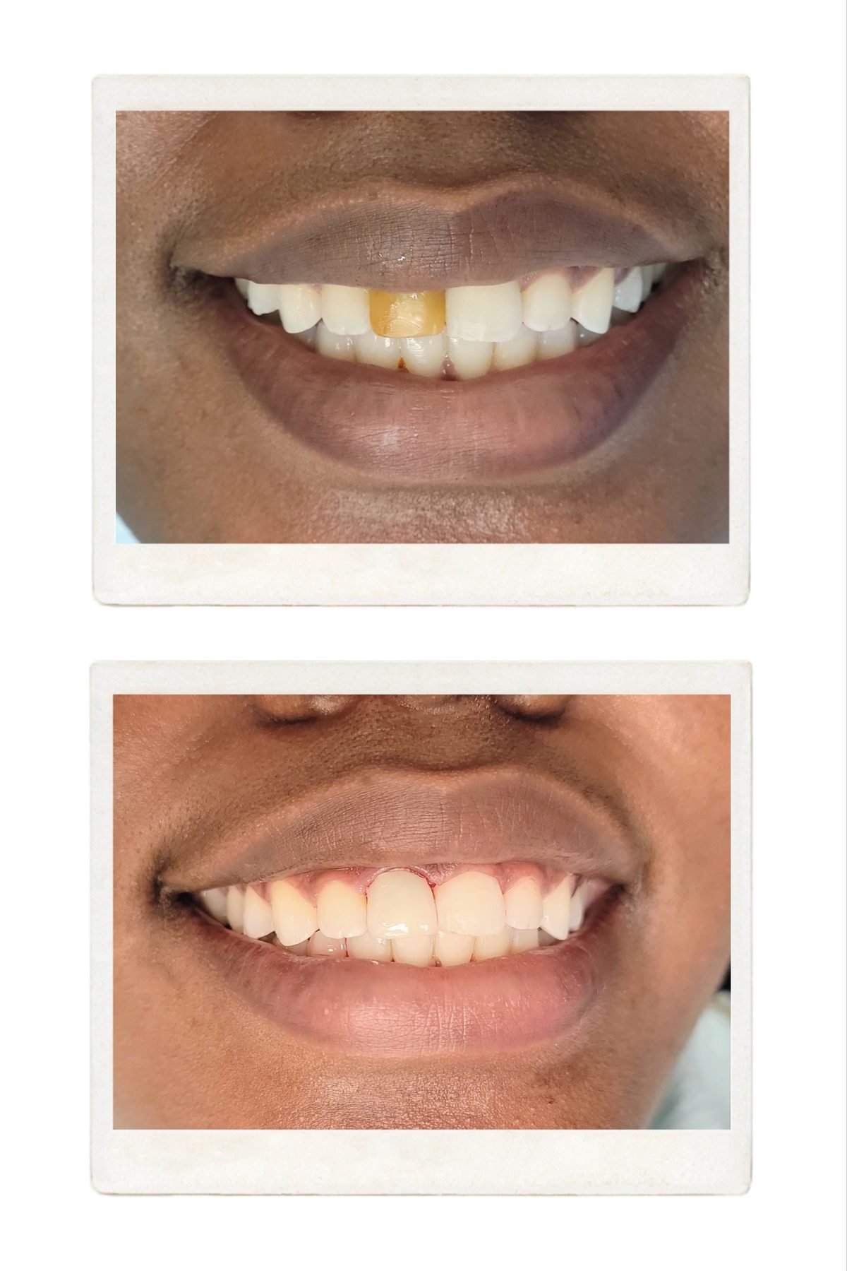 Crown — Smile Studio patient result