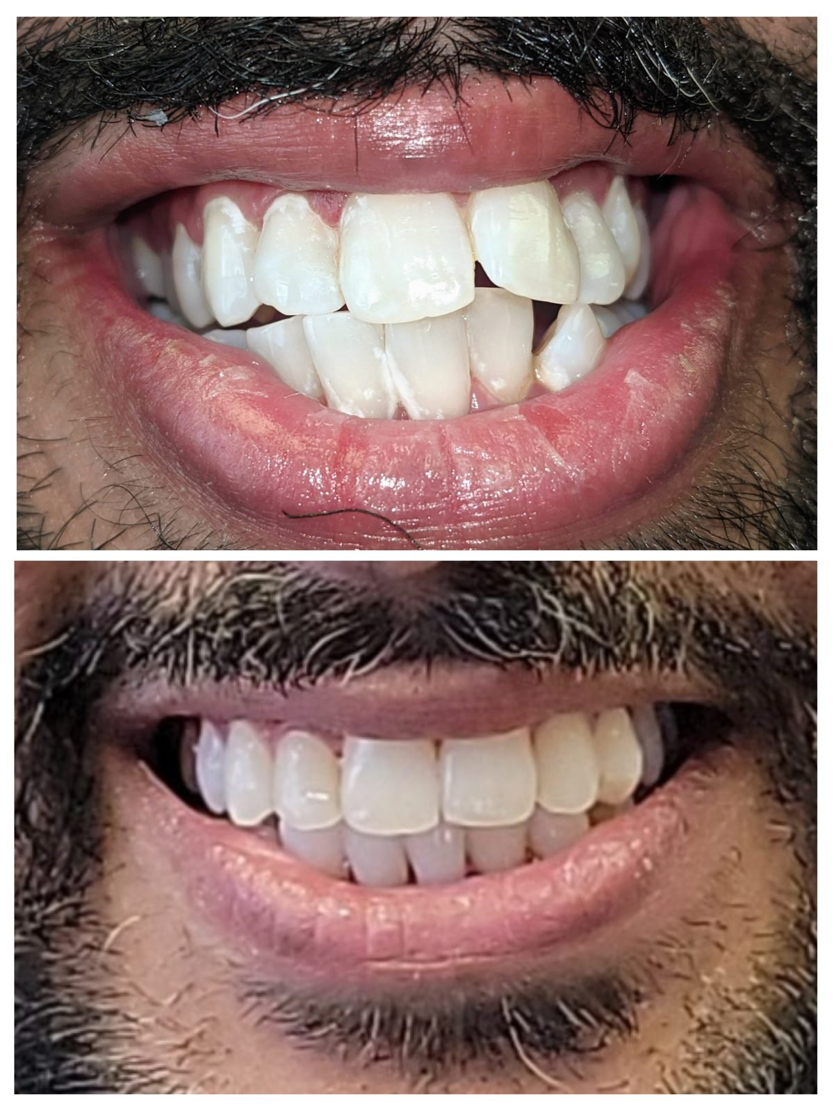 Invisalign — Smile Studio patient result