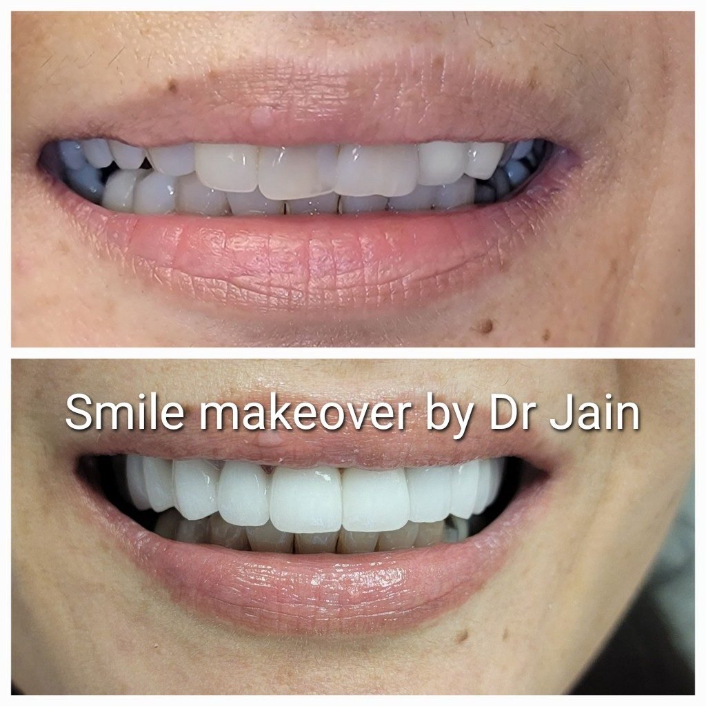 Veneer — Smile Studio patient result