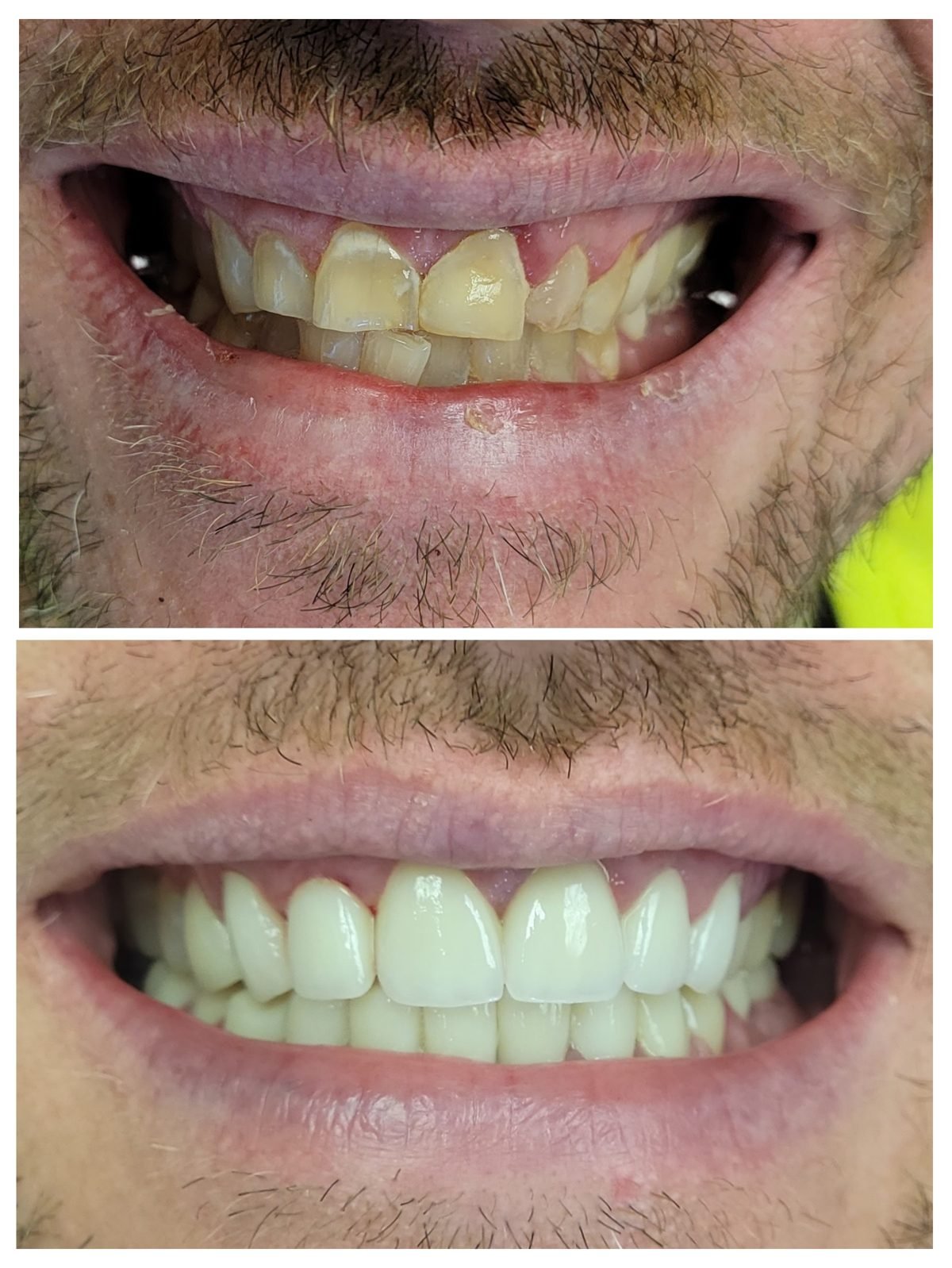 Veneer — Smile Studio patient result
