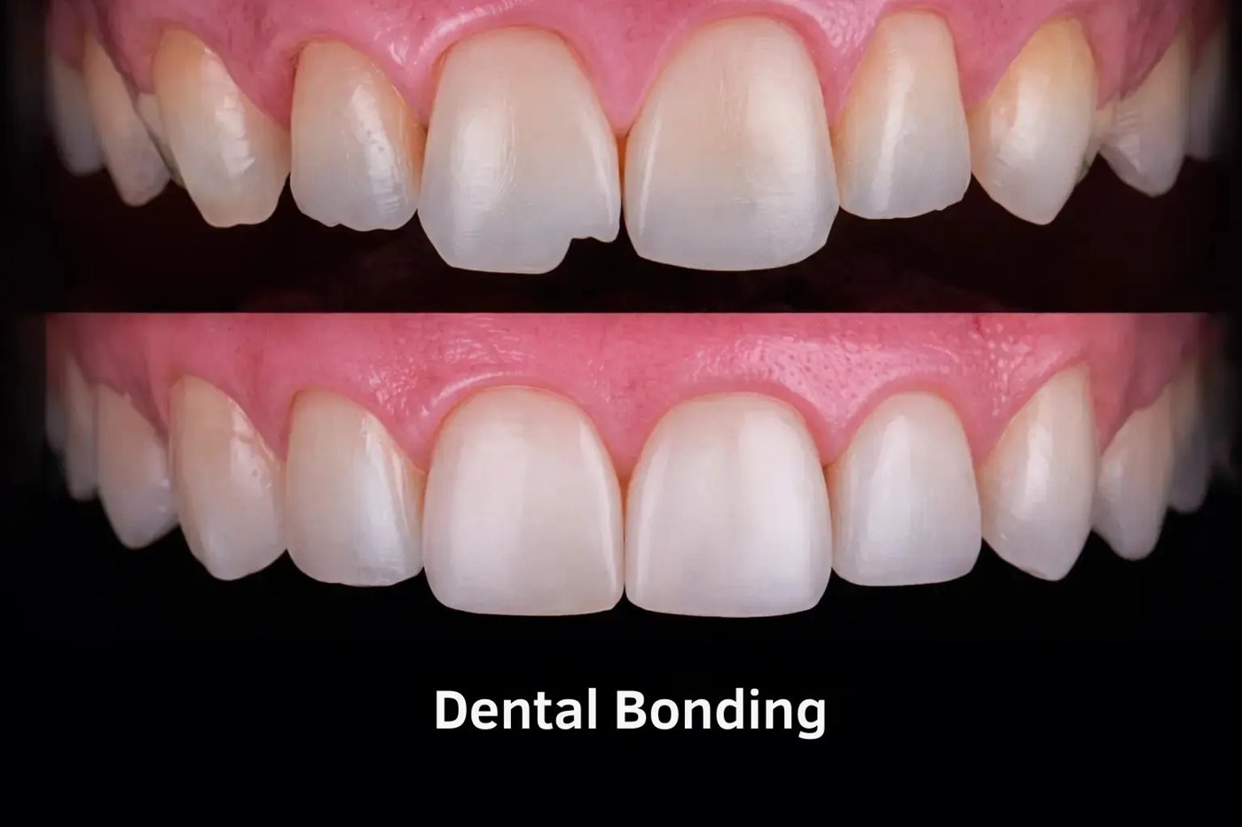 Before and after composite bonding on chipped front teeth