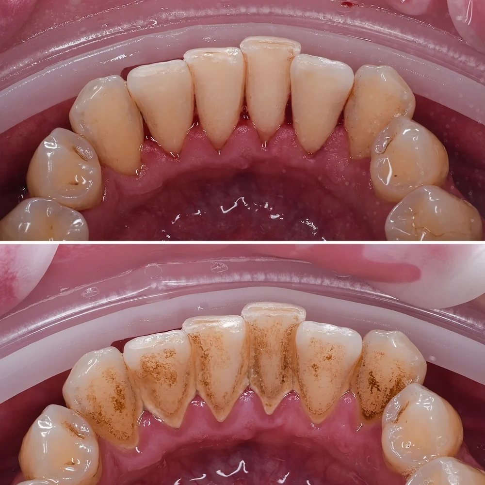 Before and after a professional dental cleaning removing tartar buildup