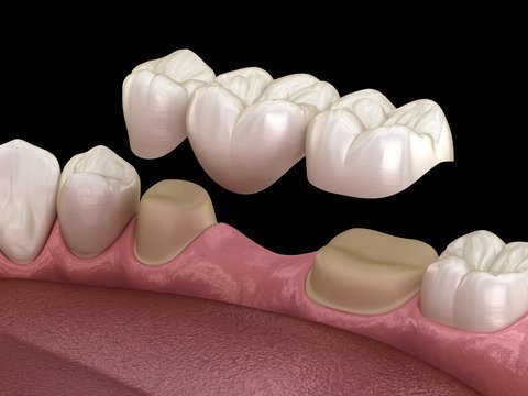 Dental bridge illustration showing crowns on prepared teeth
