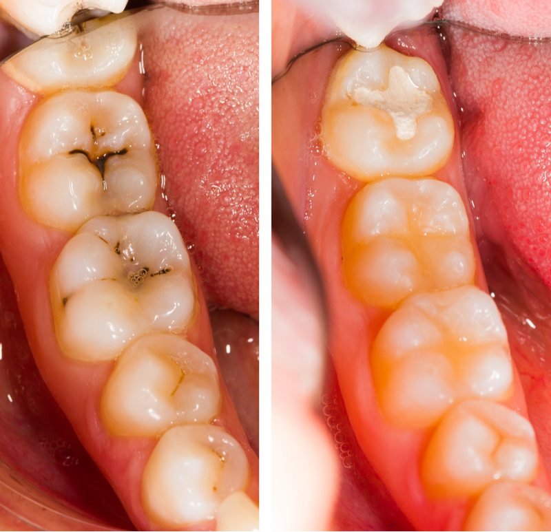 Before and after tooth-colored composite fillings on molars