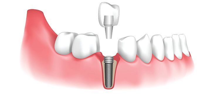 Dental implant diagram showing titanium post and crown