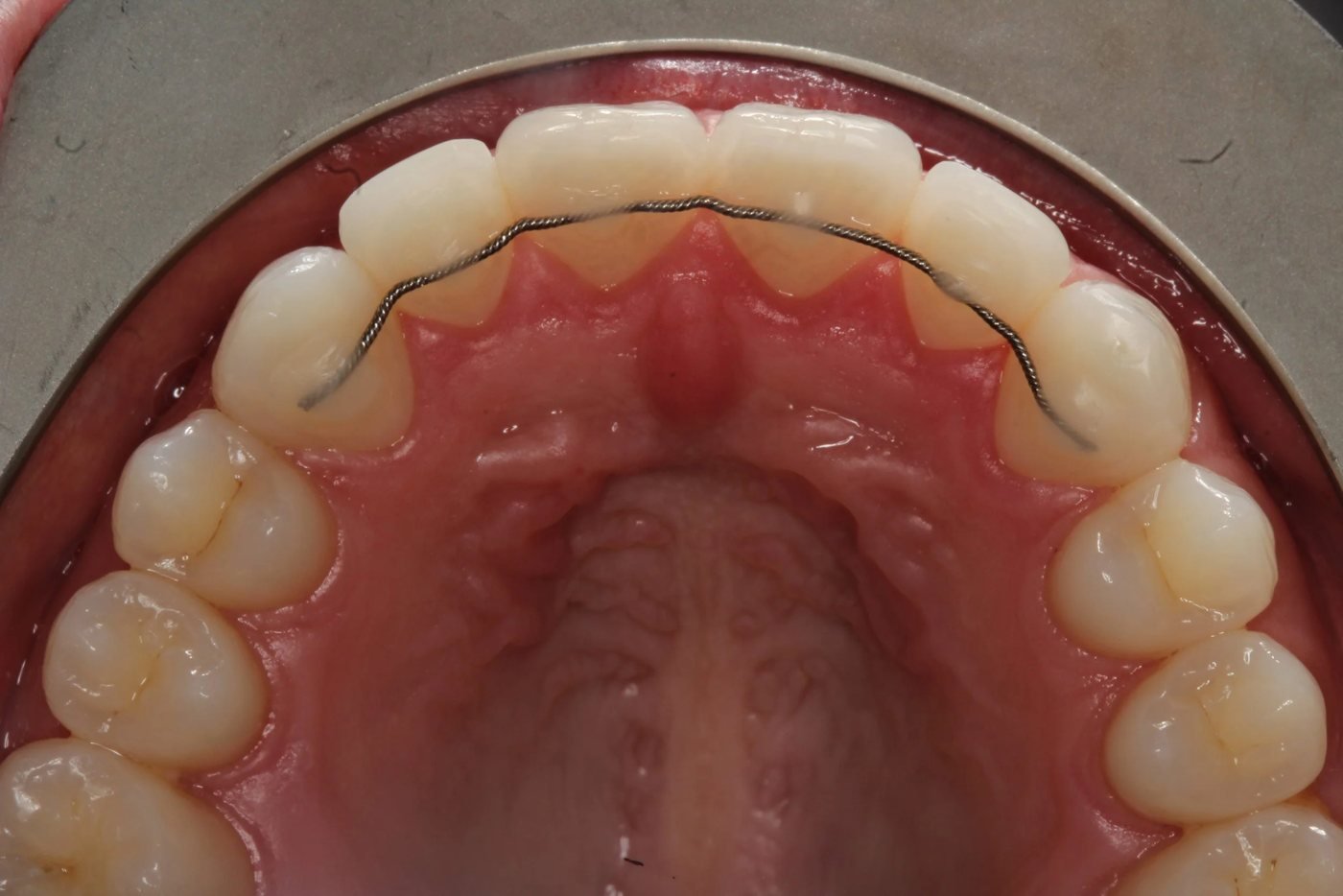 Fixed bonded retainer wire behind the upper front teeth