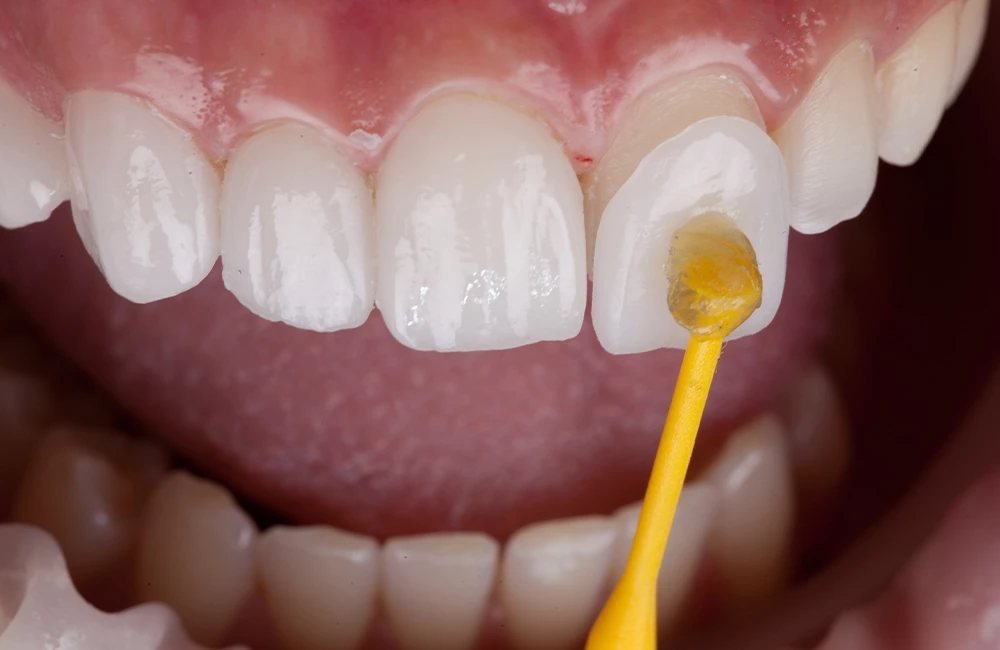 Porcelain veneer being bonded to a front tooth