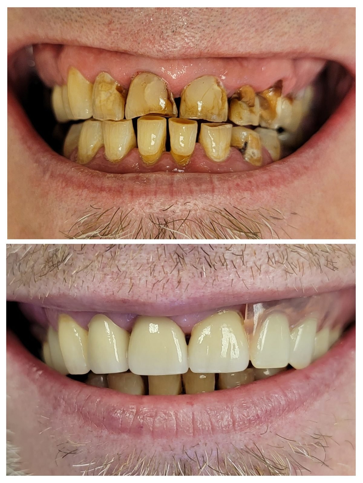 Crowns and partial denture — Smile Studio patient result