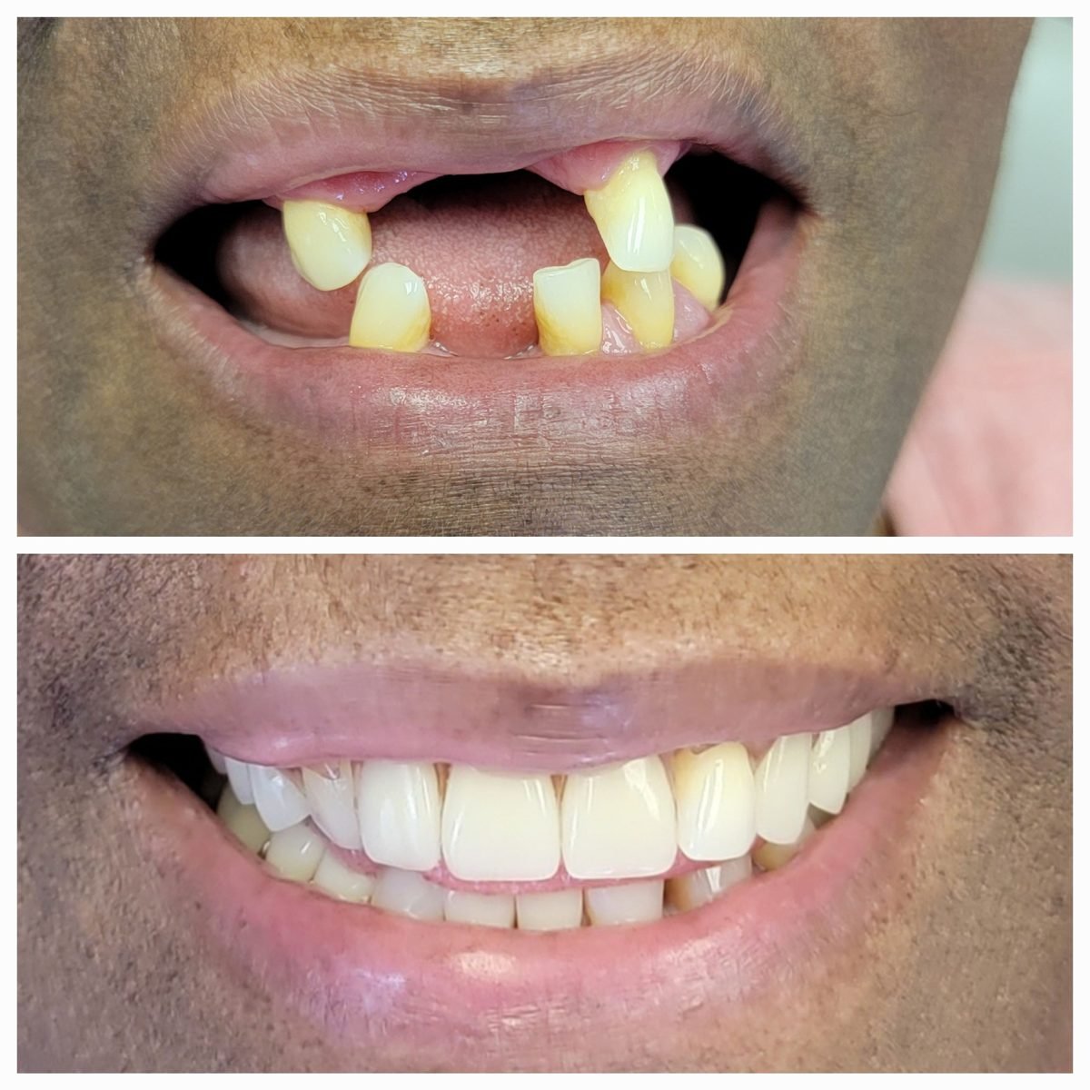 Partial denture — Smile Studio patient result