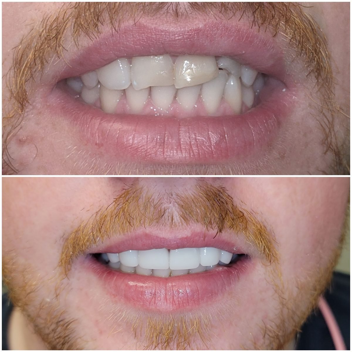 Veneer — Smile Studio patient result