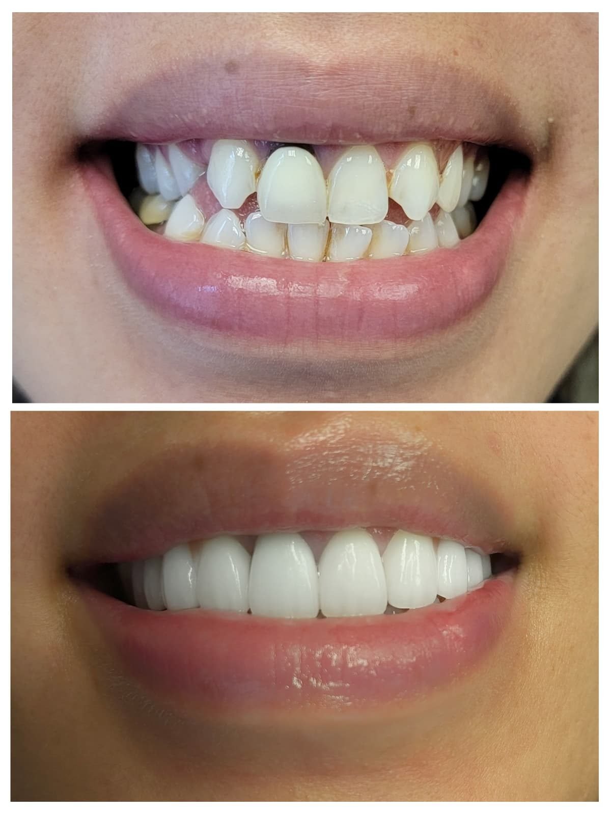 Full smile makeover with crowns and veneers — Smile Studio patient result